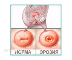 Круглосуточно ПРИЕМ ГИНЕКОЛОГА скидка 50%! Стаж более 10лет!