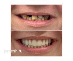 СТОМАТОЛОГИЯ! +7 985 803 66 22 метро Площадь Ильичага 3мин